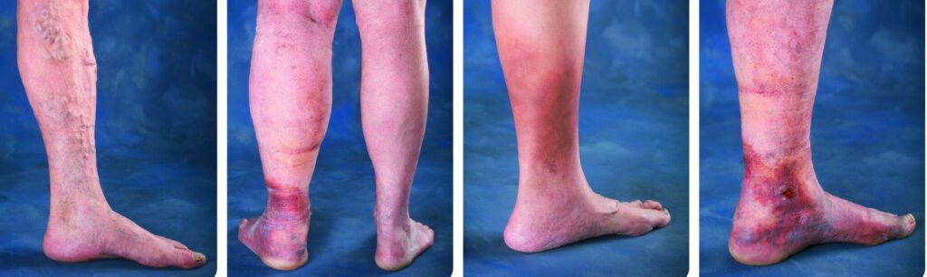 Venous Disease Progression Image e1473842404609